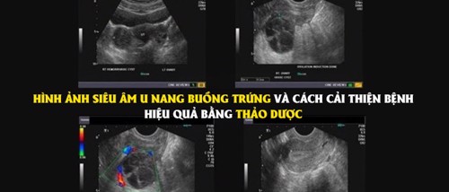 Hình ảnh siêu âm u nang buồng trứng và cách cải thiện bệnh hiệu quả bằng thảo dược